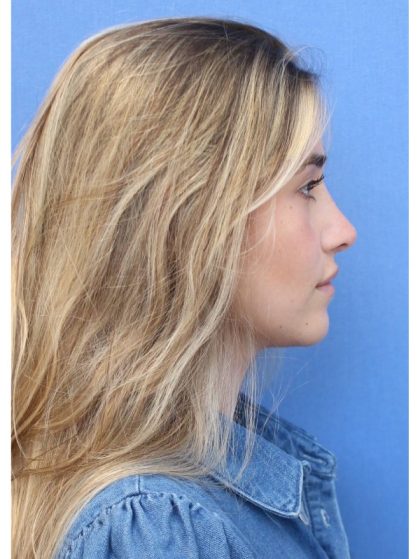 Primary Rhinoplasty Before & After Patient #742
