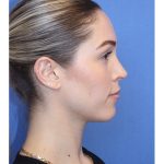 Primary Rhinoplasty Before & After Patient #743