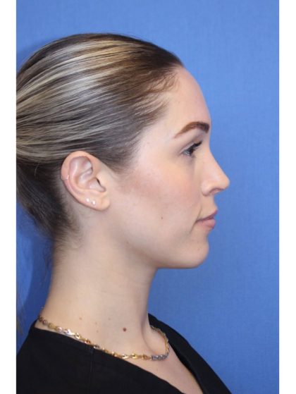 Primary Rhinoplasty Before & After Patient #743