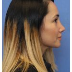 Primary Rhinoplasty Before & After Patient #775