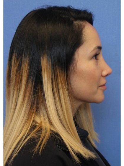 Primary Rhinoplasty Before & After Patient #775