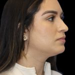 Primary Rhinoplasty Before & After Patient #856