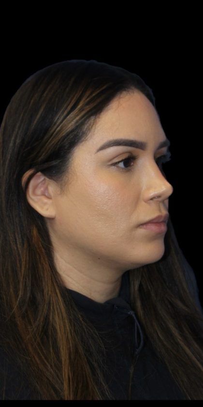Primary Rhinoplasty Before & After Patient #856