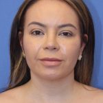 Primary Rhinoplasty Before & After Patient #77