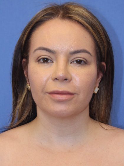 Primary Rhinoplasty Before & After Patient #77