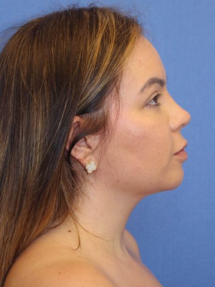 Primary Rhinoplasty Before & After Patient #77