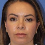 Primary Rhinoplasty Before & After Patient #77