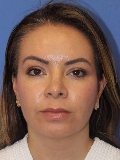 Primary Rhinoplasty Before & After Patient #77