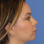 Primary Rhinoplasty Before & After Patient #77