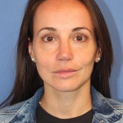 Primary Rhinoplasty Before & After Patient #76