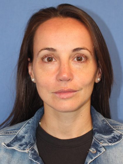 Primary Rhinoplasty Before & After Patient #76