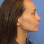 Primary Rhinoplasty Before & After Patient #76