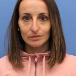Primary Rhinoplasty Before & After Patient #76