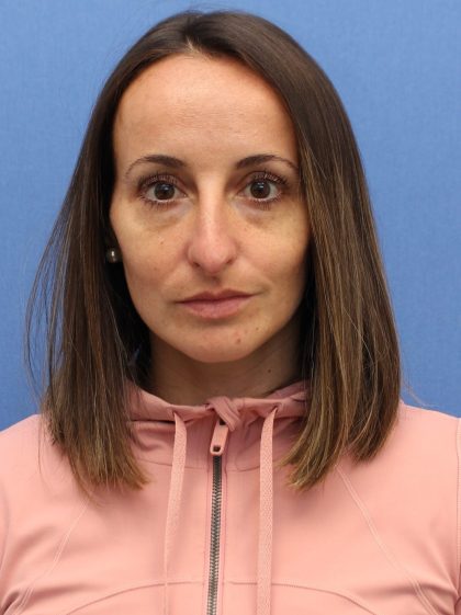 Primary Rhinoplasty Before & After Patient #76