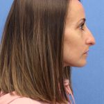 Primary Rhinoplasty Before & After Patient #76