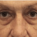 Blepharoplasty Before & After Patient #388