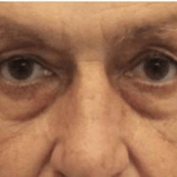 Blepharoplasty Before & After Patient #388