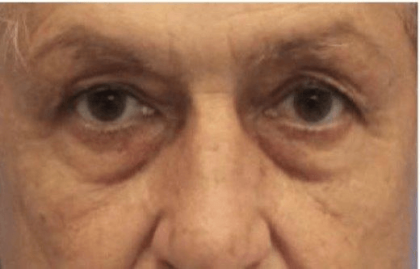 Blepharoplasty Before & After Patient #388
