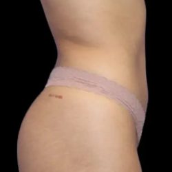 Brazilian Butt Lift Before & After Patient #404