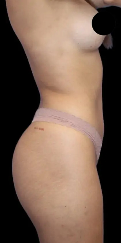 Brazilian Butt Lift Before & After Patient #404