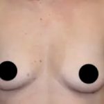 Breast Augmentation Before & After Patient #497