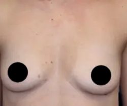 Breast Augmentation Before & After Patient #497