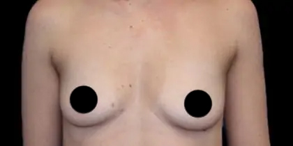 Breast Augmentation Before & After Patient #497