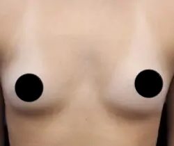 Breast Augmentation Before & After Patient #499