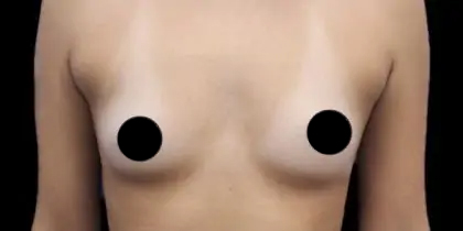 Breast Augmentation Before & After Patient #499