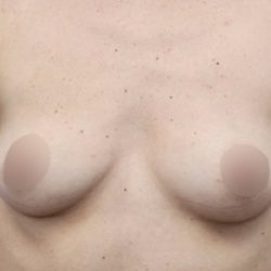 Breast Augmentation Before & After Patient #500