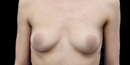 Breast Augmentation Before & After Patient #500
