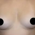 Breast Augmentation Before & After Patient #501