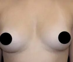 Breast Augmentation Before & After Patient #501