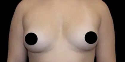 Breast Augmentation Before & After Patient #501