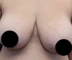 Breast Lift Before & After Patient #534