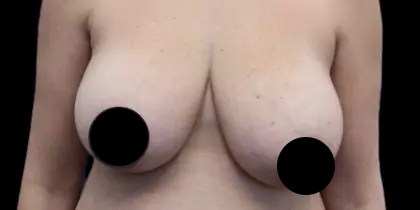 Breast Lift Before & After Patient #534