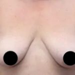 Breast Lift Before & After Patient #535