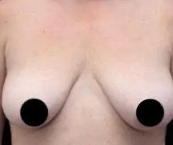 Breast Lift Before & After Patient #535