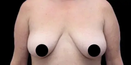 Breast Lift Before & After Patient #535
