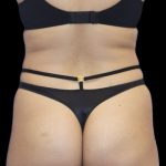 Brazilian Butt Lift Before & After Patient #403