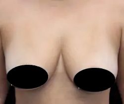 Breast Lift Before & After Patient #536
