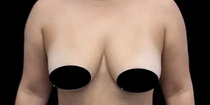 Breast Lift Before & After Patient #536