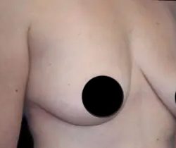 Breast Lift Before & After Patient #537