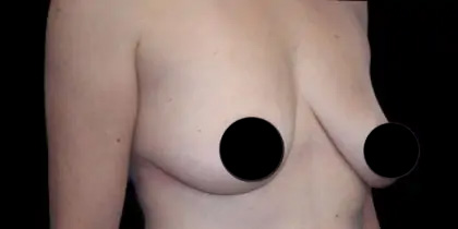 Breast Lift Before & After Patient #537