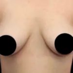 Breast Lift Before & After Patient #539