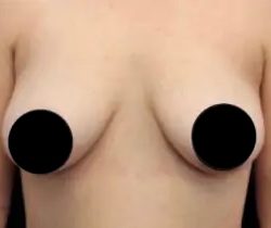 Breast Lift Before & After Patient #539