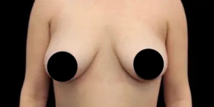 Breast Lift Before & After Patient #539