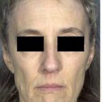Facelift Before & After Patient #573