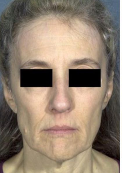 Facelift Before & After Patient #573