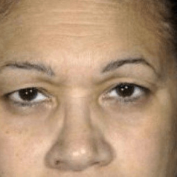 Blepharoplasty Before & After Patient #389